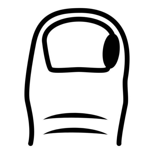 Sissekasvanud küüs