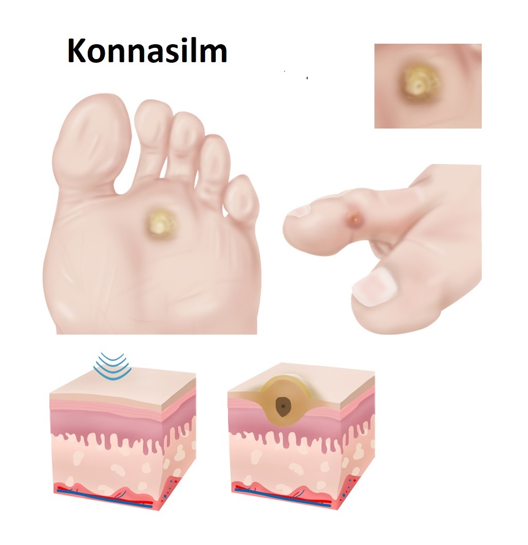 konnasilm