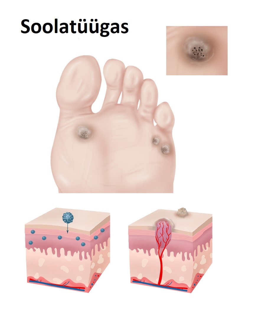 Soolatüügas